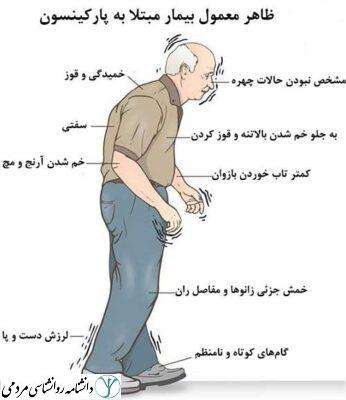 پارکینسون
