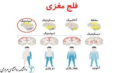 فلج مغزی